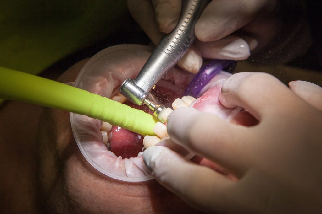 De ce să alegi tratamentul cu implanturi dentare
