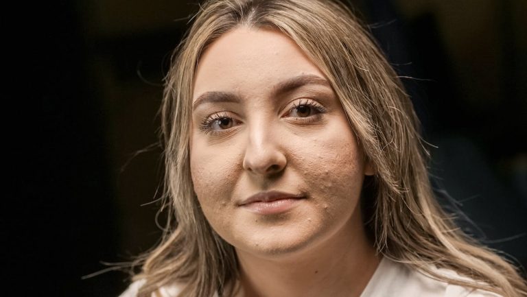 Secrete ale luptei cu acneea: De ce te confrunți cu această problemă