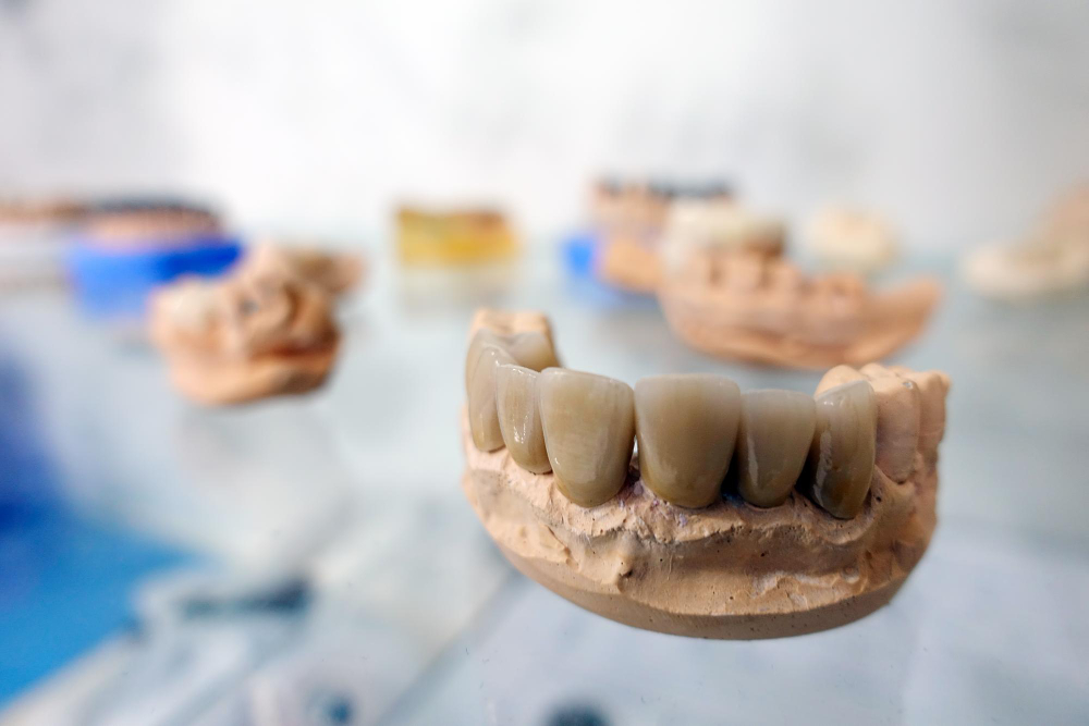 implanturi dentare